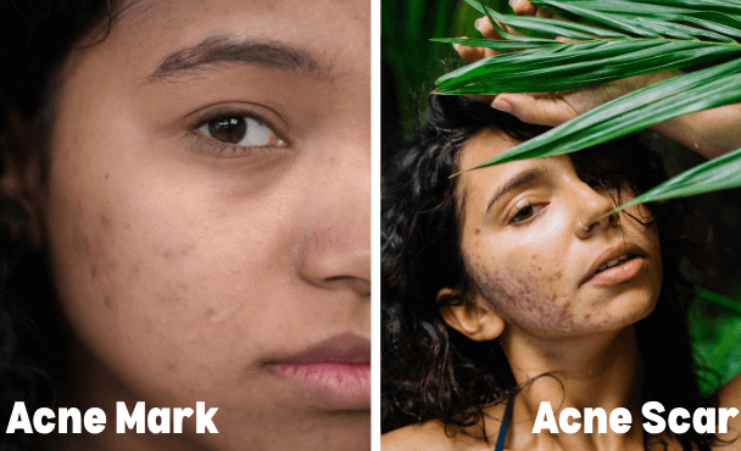 Acne Scar Treatment in Lucknow